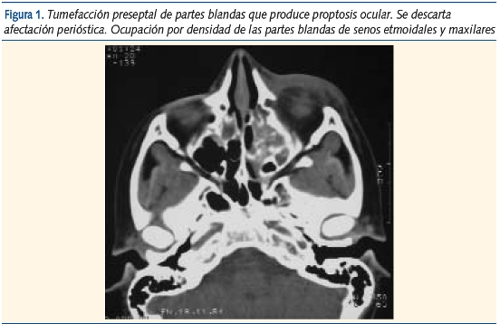 Figura 1. Tumefacción preseptal de partes blandas que produce proptosis ocular. Se descarta
afectación perióstica. Ocupación por densidad de las partes blandas de senos etmoidales y maxilares